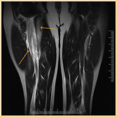 what test shows muscle tears|mri for torn muscles.